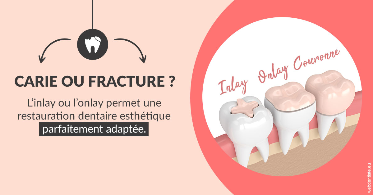 https://selarl-olivier-demonceaux.chirurgiens-dentistes.fr/T2 2023 - Carie ou fracture 2