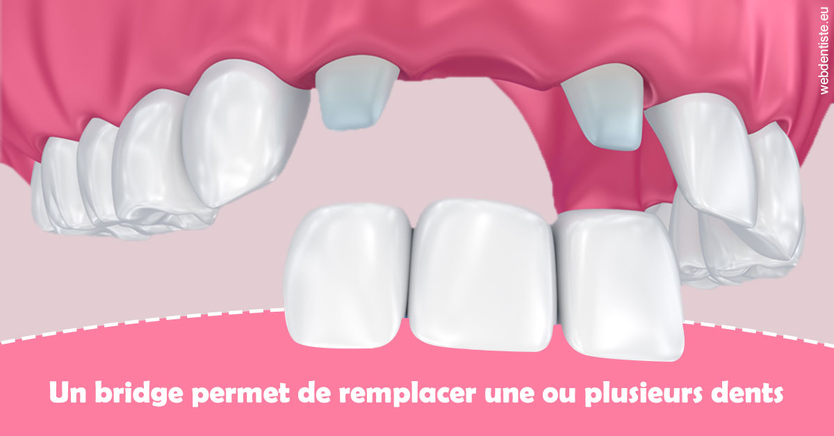https://selarl-olivier-demonceaux.chirurgiens-dentistes.fr/Bridge remplacer dents 2