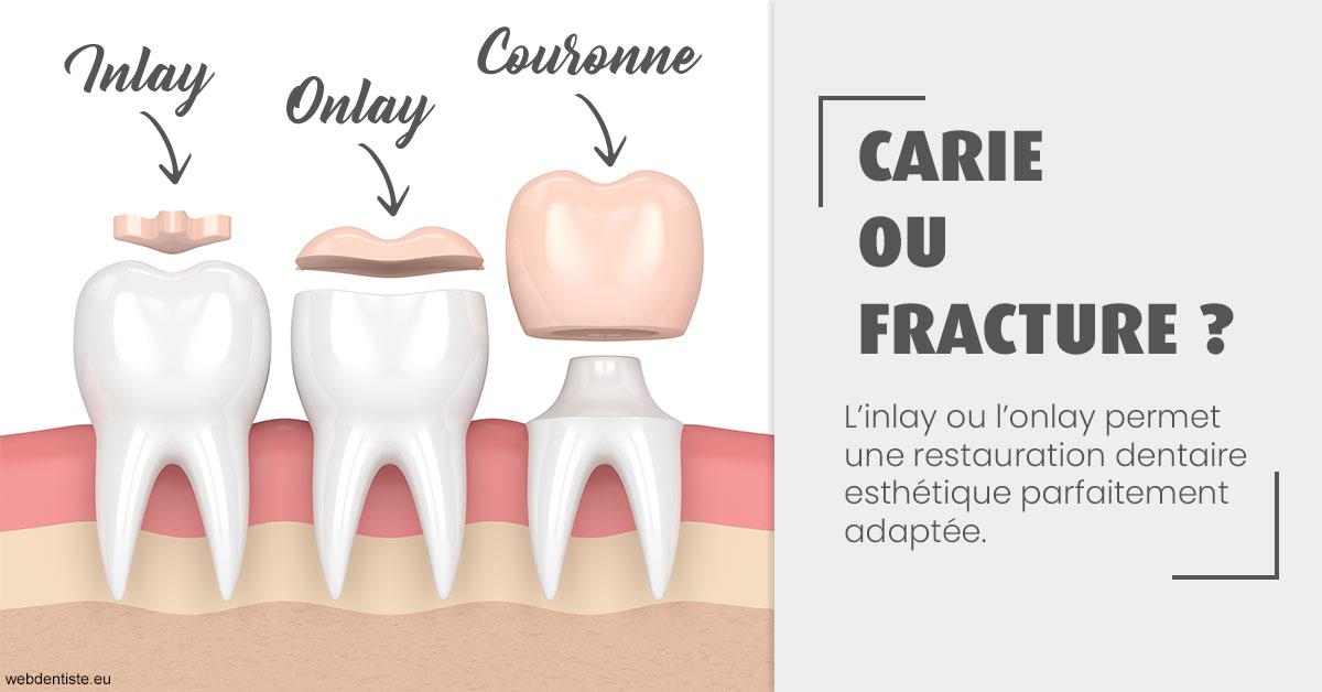 https://selarl-olivier-demonceaux.chirurgiens-dentistes.fr/T2 2023 - Carie ou fracture 1