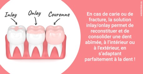 https://selarl-olivier-demonceaux.chirurgiens-dentistes.fr/L'INLAY ou l'ONLAY 2